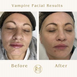 PRP/ Vampire Facial<span class="d-block fw-normal">Treatment</span>
